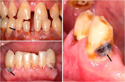 Pronounced Effect of Antibacterial Bioactive Dental Composite on Microcosm Biofilms Derived From Patients With Root Carious Lesions